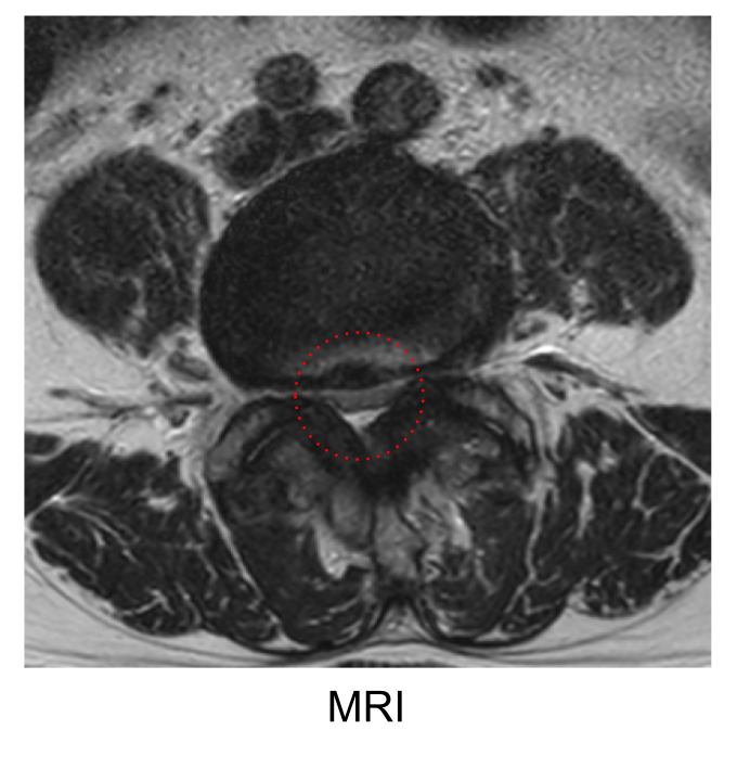 腰部脊柱管狭窄症の解説図（脊柱管が狭くなり神経が圧迫される様子）
