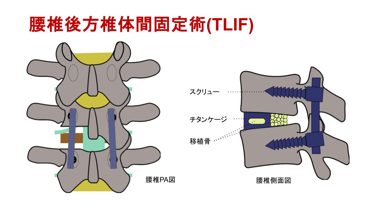 腰椎後方椎体間固定術（TLIF）の解説図。スクリューとチタンケージ、移植骨を用いて背骨を固定する