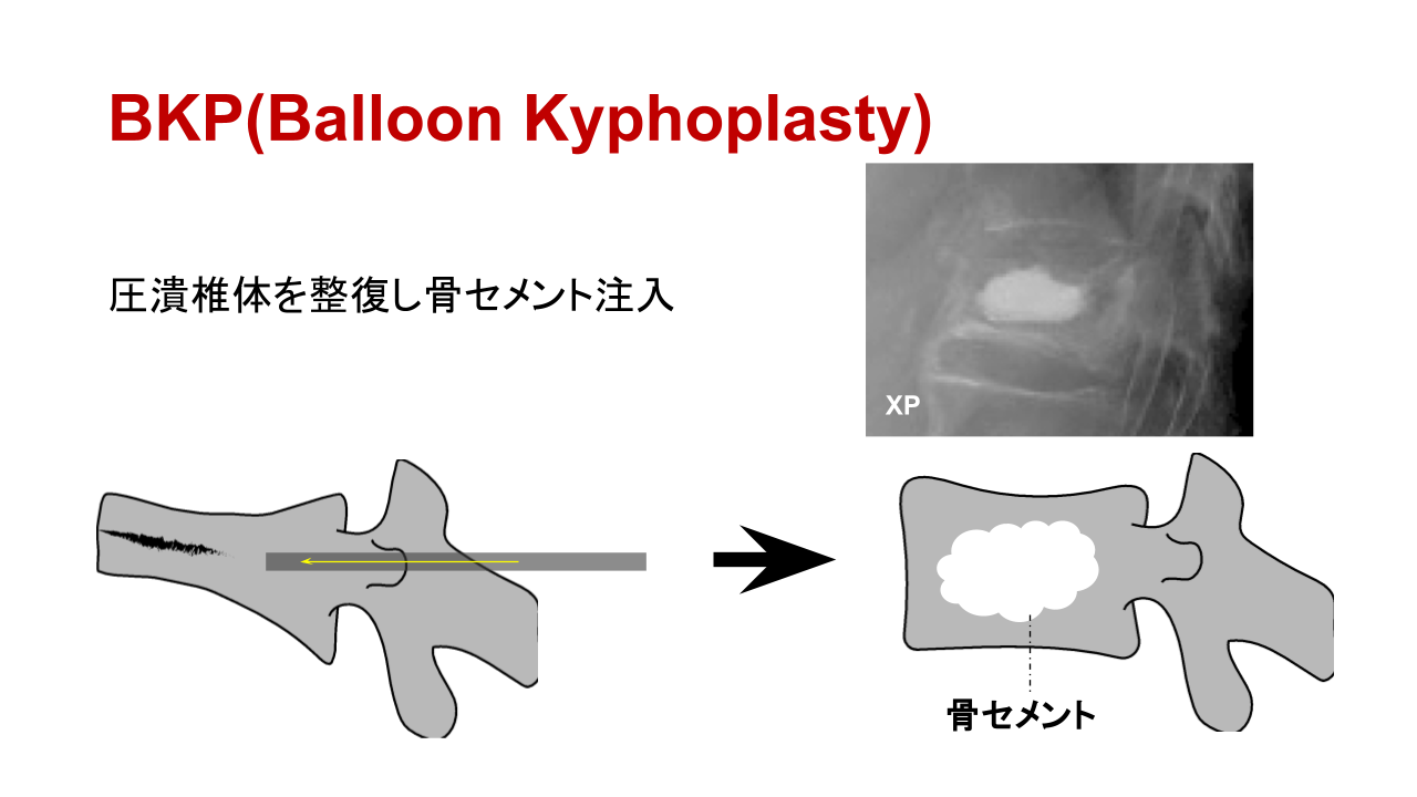 経皮的椎体形成術（BKP）の解説図。つぶれた椎体に骨セメントを注入する