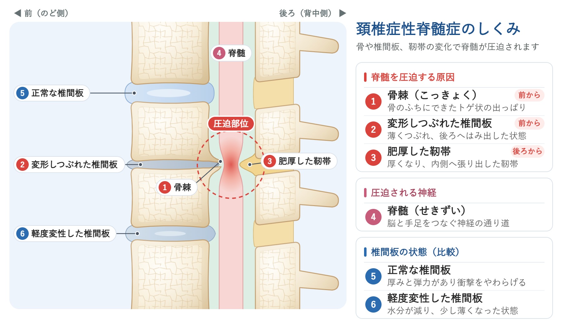 頚椎症性脊髄症のしくみを示す図。骨棘、変形しつぶれた椎間板、肥厚した靭帯によって、脊髄が前後から圧迫される様子を示している