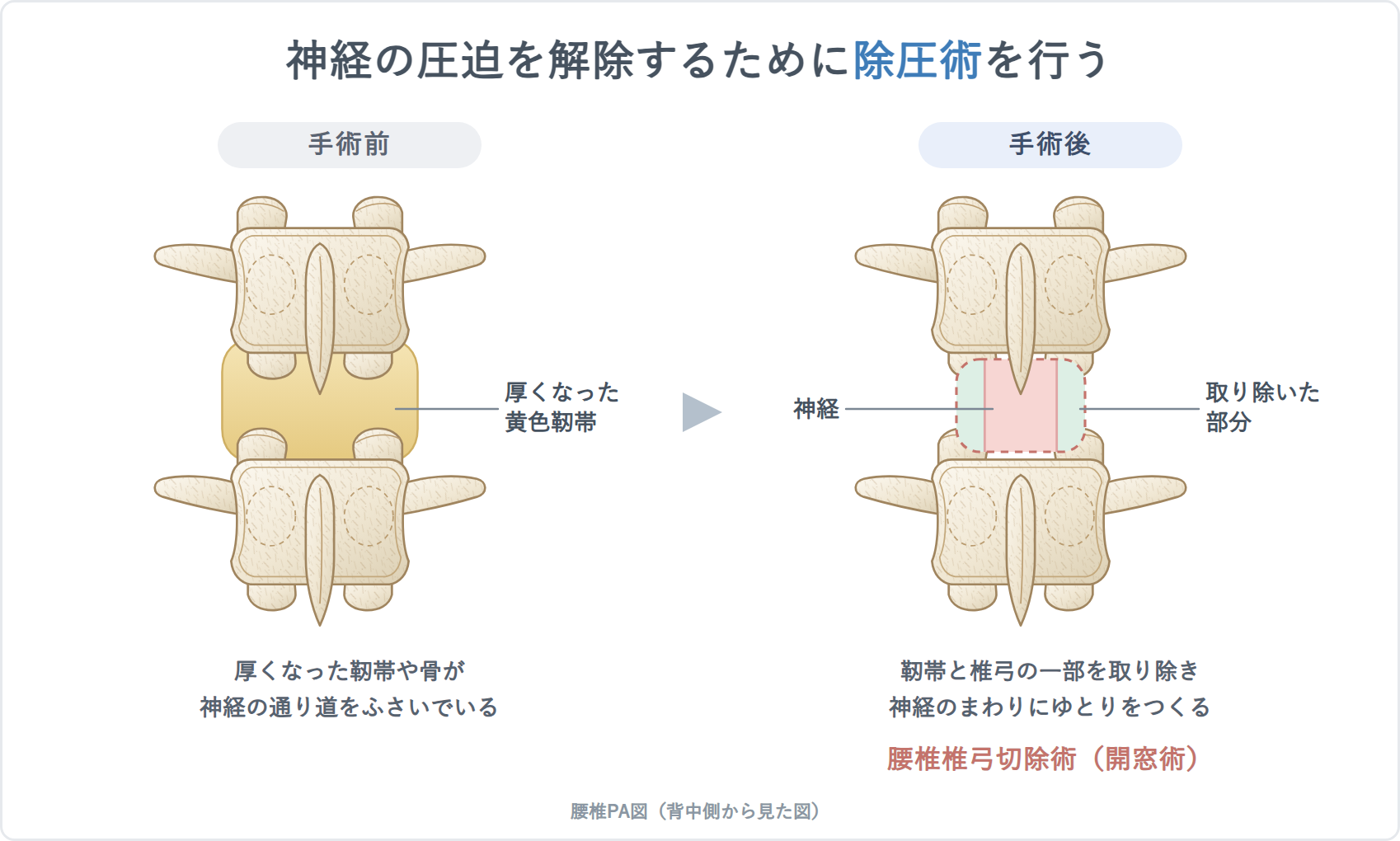 除圧術（腰椎椎弓切除術・開窓術）の解説図