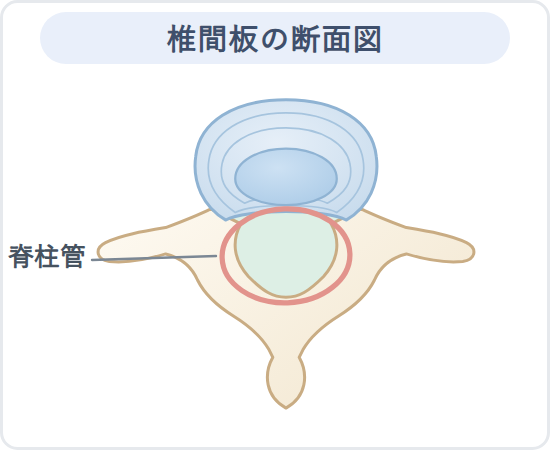椎間板の断面図（模式図）。背骨を輪切りにした図で、中央の緑色の部分が脊柱管＝神経の通り道