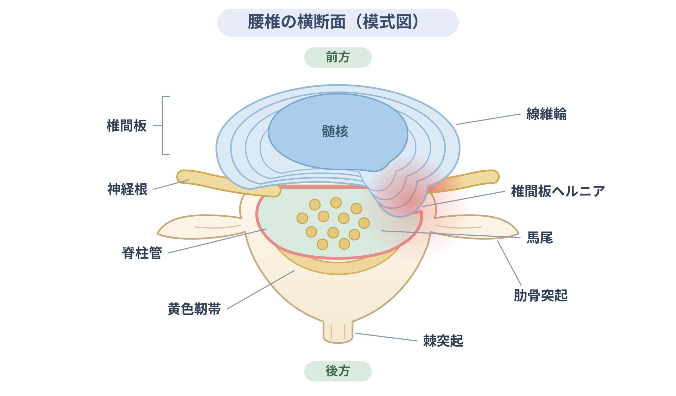 腰椎の横断面と椎間板ヘルニアの模式図。線維輪の内側にある髄核が後方へ飛び出し、神経根と馬尾を圧迫している