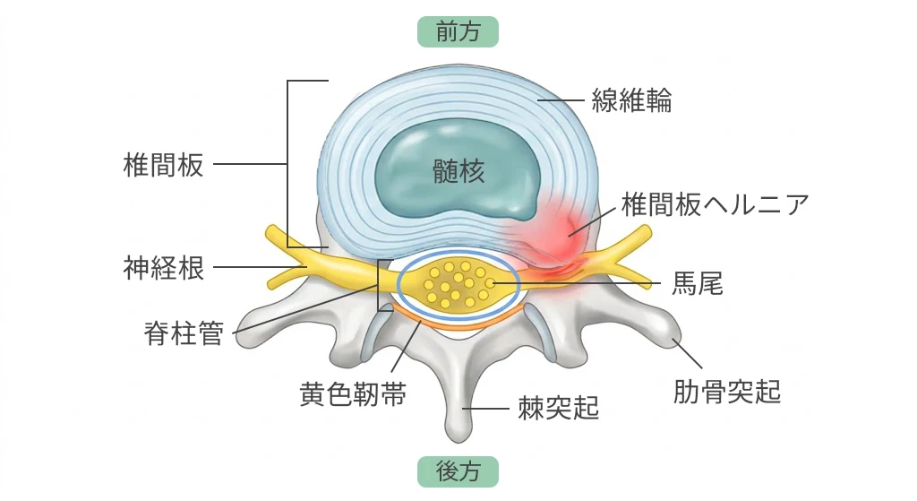 腰椎の横断面と椎間板ヘルニアの模式図。線維輪の内側にある髄核が後方へ飛び出し、神経根と馬尾を圧迫している