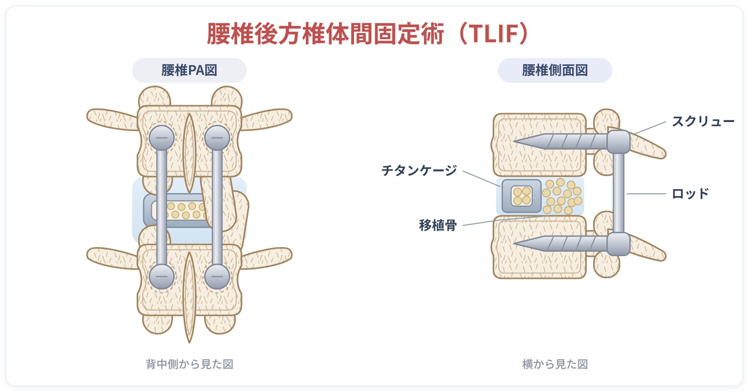 腰椎後方椎体間固定術（TLIF）の解説図。スクリューとチタンケージ、移植骨を用いて背骨を固定する