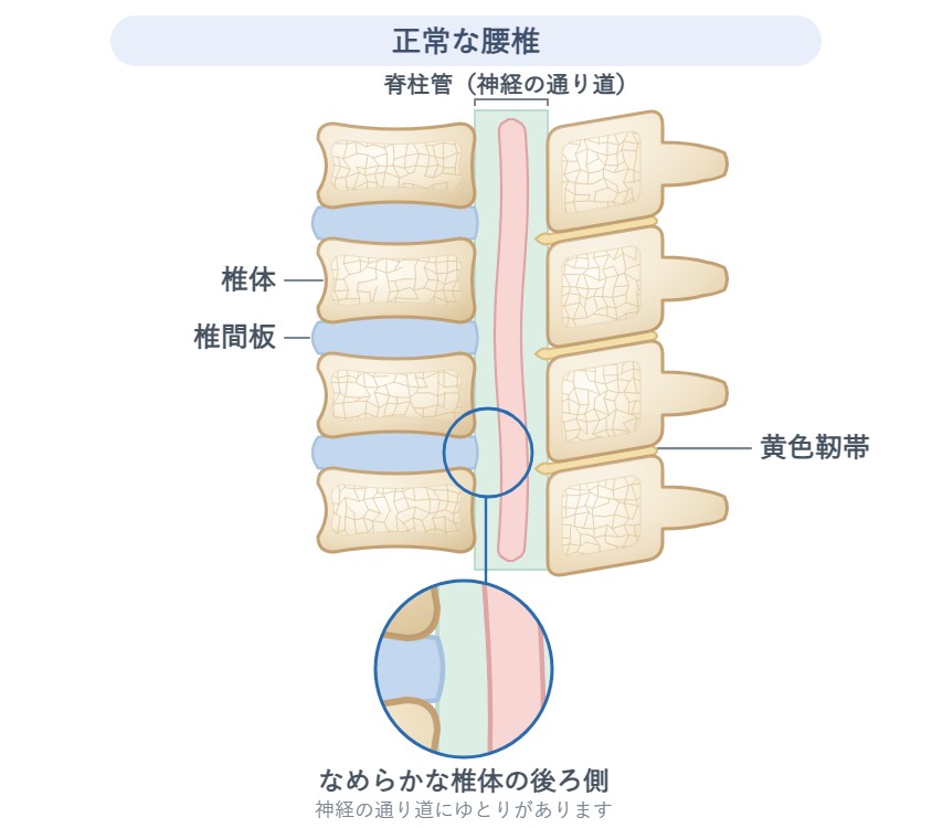 正常な腰椎の模式図。椎体・椎間板・黄色靭帯・脊柱管を示し、椎体の後ろ側がなめらかで神経の通り道にゆとりがある状態