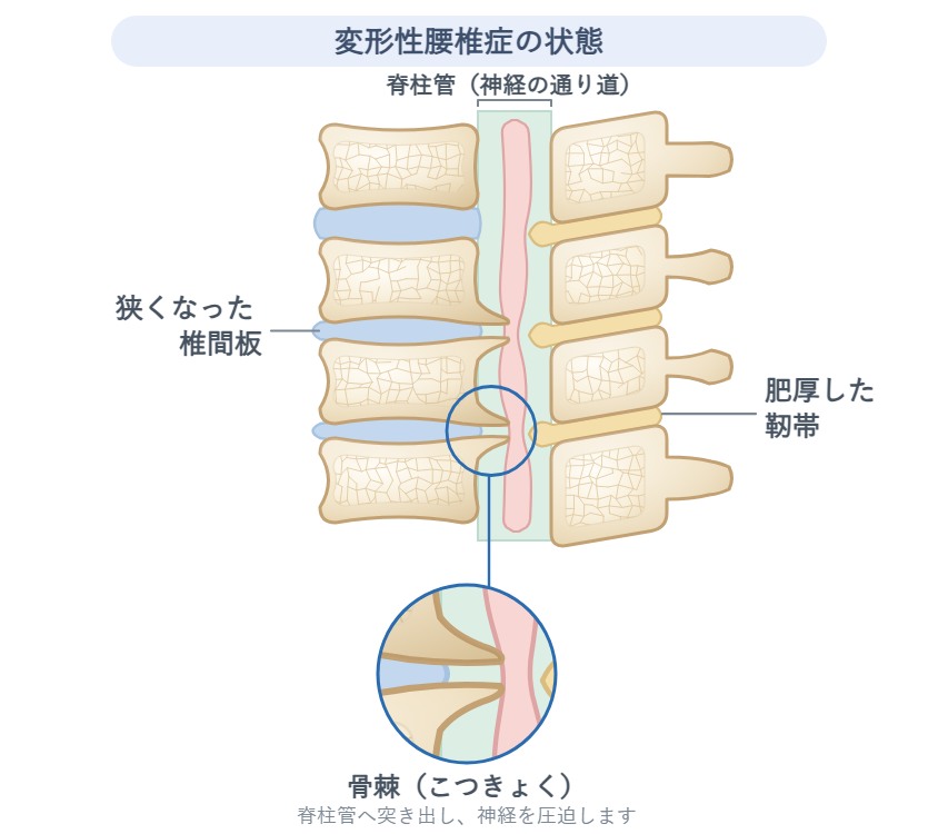 変形性腰椎症の模式図。狭くなった椎間板、肥厚した靭帯、脊柱管へ突き出した骨棘を示している