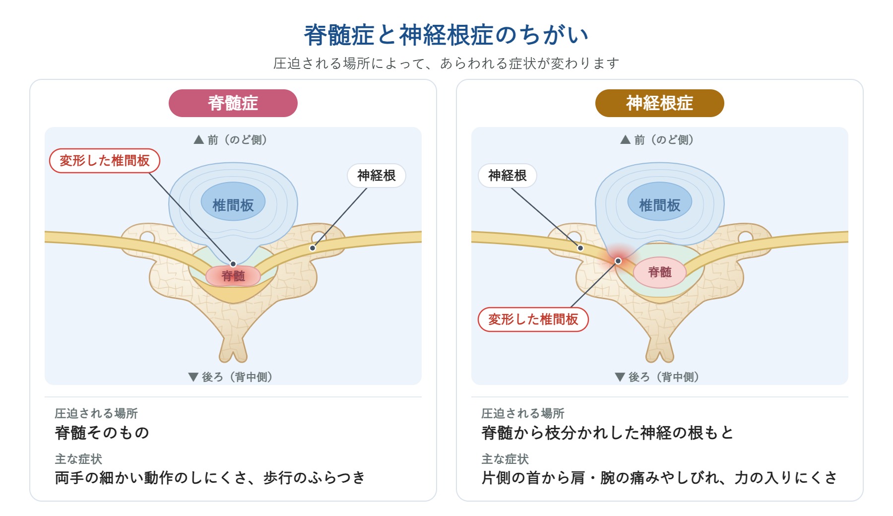 脊髄症と神経根症の比較図。脊髄症は脊髄そのものが圧迫されて両手の細かい動作のしにくさや歩行のふらつきが、神経根症は神経の根もとが圧迫されて片側の首から肩・腕の痛みやしびれが出ることを示している