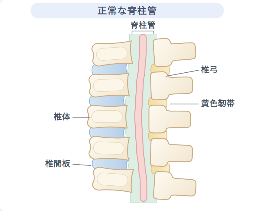正常な脊柱管の図。椎体・椎間板・椎弓・黄色靭帯に囲まれた脊柱管が十分な広さを保っている状態