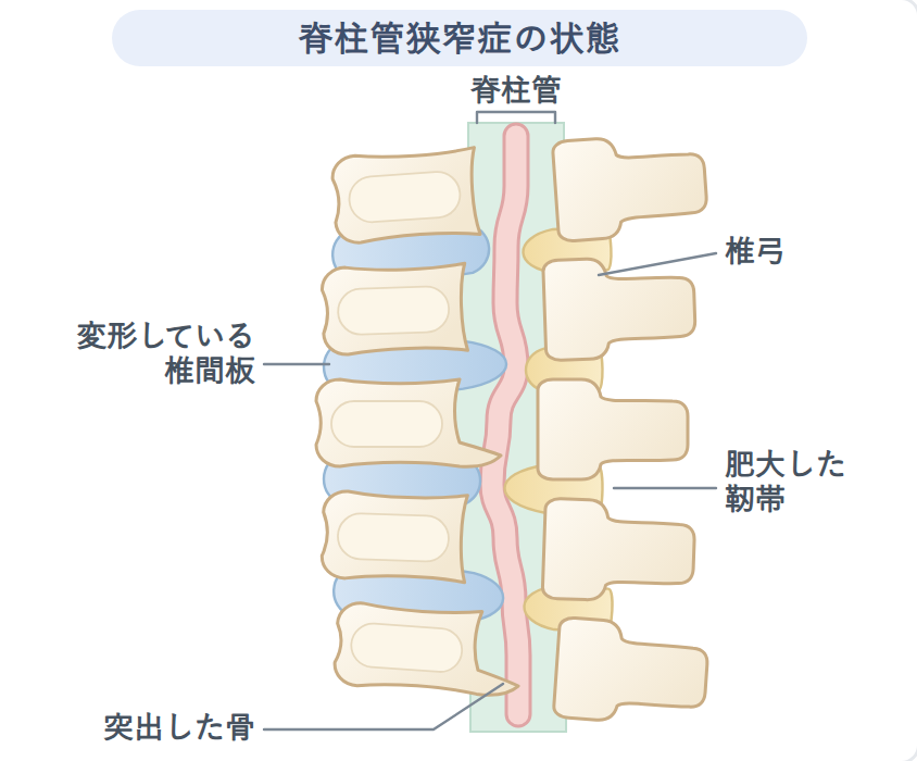 脊柱管狭窄症の状態の図。変形した椎間板・肥大した靭帯・突出した骨により脊柱管が狭くなり神経が圧迫されている状態
