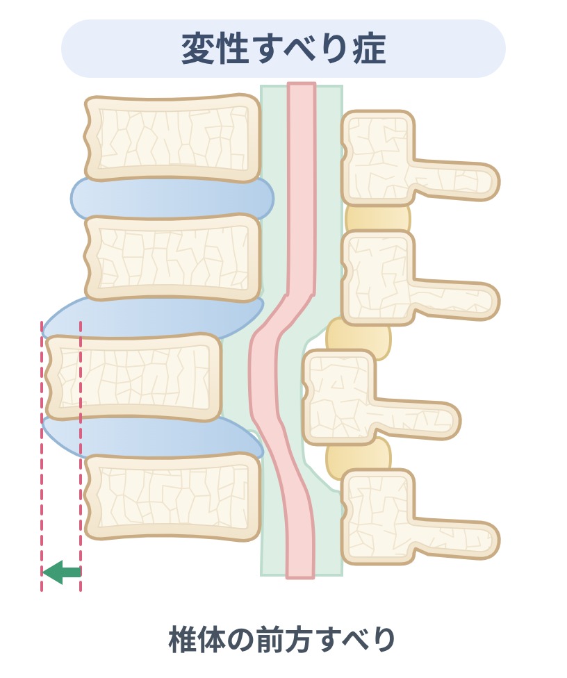 変性すべり症の解説図。椎間板や椎間関節の変性により、椎体が前方へすべっている状態