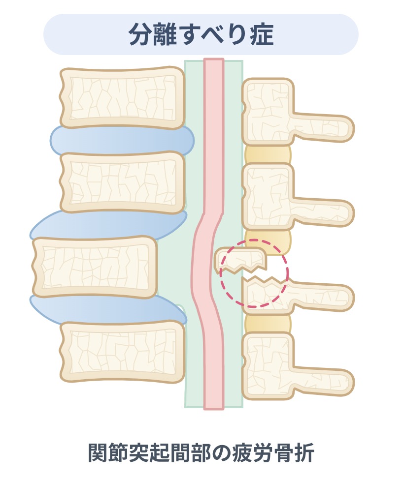 分離すべり症の解説図。椎弓の関節突起間部に疲労骨折（腰椎分離症）が生じ、そこを土台に椎体がずれている状態